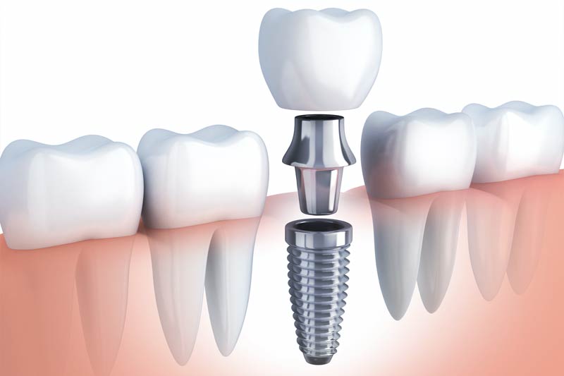 Dental Implant Restorations in Seattle
