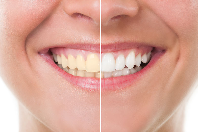 Teeth Whitening in Seattle