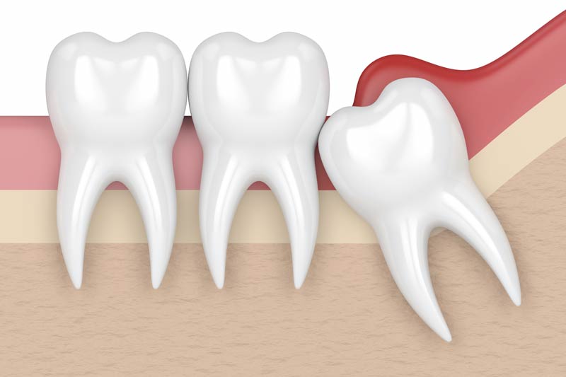 Wisdom Tooth Removal in Seattle